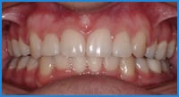 Athena's teeth after treatment Athena's teeth after orthodontic treatment