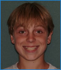 Austin's smile before treatment with Invisalign Teen Austin's smile before treatment with Invisalign Teen