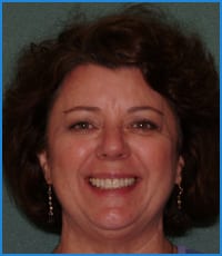 Carol's smile after clear aligner treatment Carol's smile after treatment with clear aligners