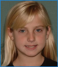 Caroleana before treatment Caroleana's smile before orthodontic treatment