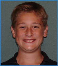 Chris before treatment Chris' smile before straightening his teeth