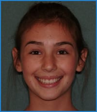 Crocket's smile after treatment Crocket's smile after teeth straightening