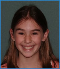 Crocket before treatment Crocket's smile before teeth straightening