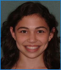 Gabrielle after treatment Gabrielle's smile after treatment