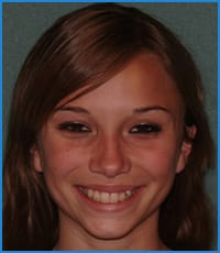 Haileigh before treatment Haileigh's smile before treatment with dental braces