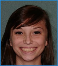 Haileigh's smile after treatment Haileigh's smile after treatment with dental braces