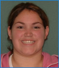 Jaquelin-1 Jaquelin before orthodontic treatment for her underbite