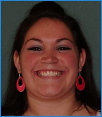 Jaquelin's smile after treatment Jaquelin after orthodontic treatment for her underbite