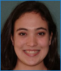 Kathryn's smile after treatment Kathryn after treatment for crowding