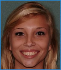 Arielle's smile after Invisalign treatment Arielle's smile after Invisalign treatment at American River Orthodontics