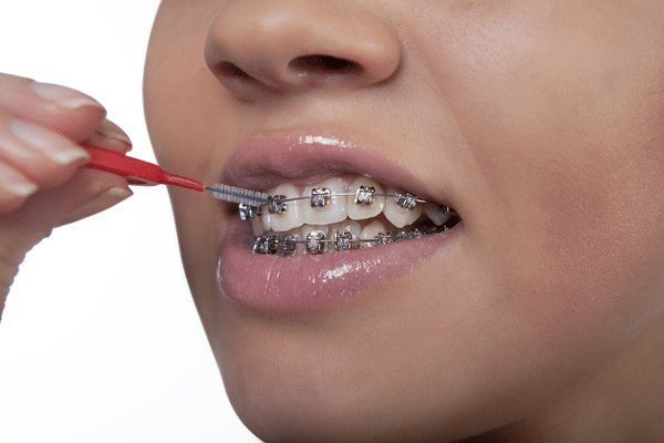 Woman cleaning metal braces. Comparing braces vs Invisalign? Learn about the differences in care and maintenance.