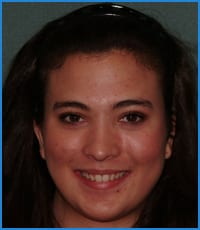 Sarah's smile after treatment Sarah before treatment with clear braces