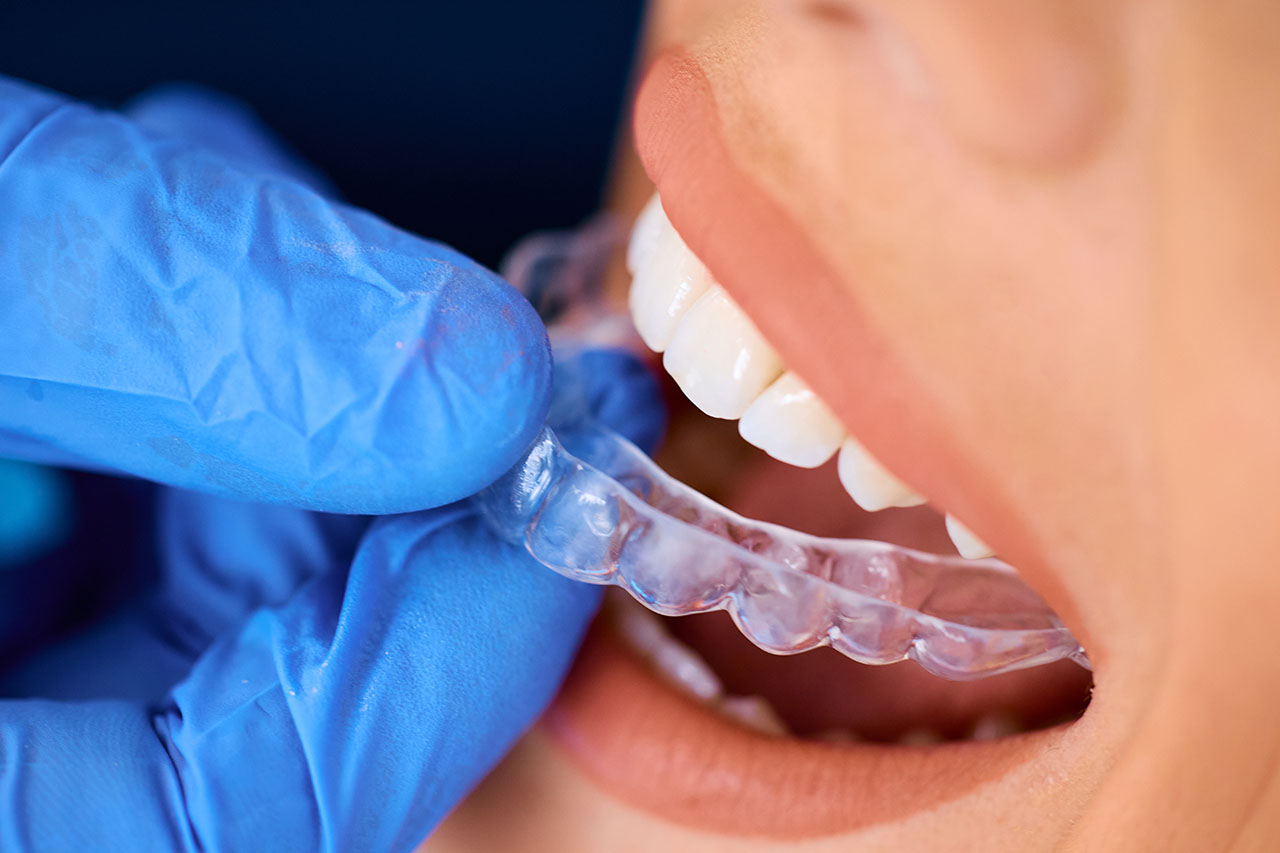 Close up photo of a gloved orthodontist hand inserting a clear retainer into patient's mouth