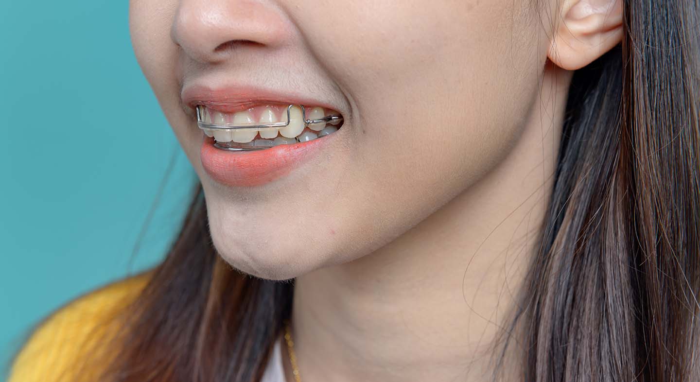 Patient smiling while wearing retainer from her orthodontist young woman wearing a Hawley retainer following orthodontic treatment