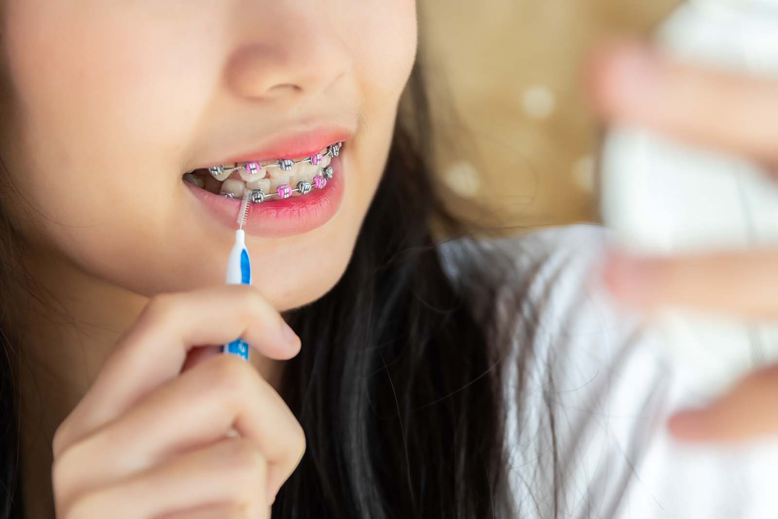 Teenage girl using an interdental brush to keep her teeth and braces clean